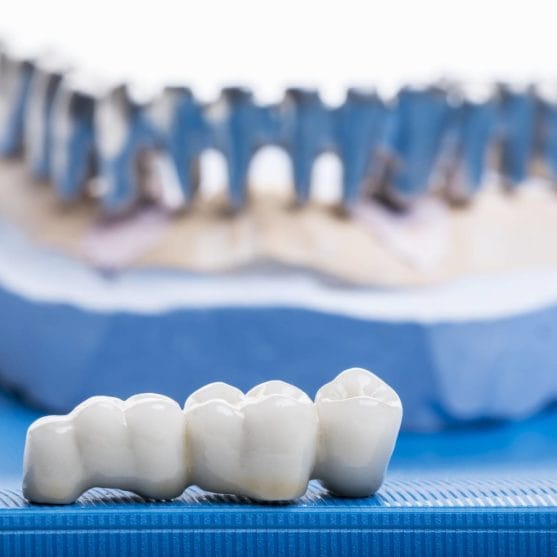 Crowns Bridges Ottawa