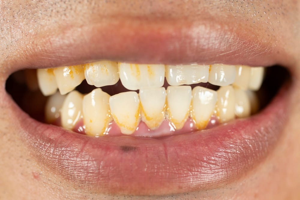 What Plaque and Tartar Really Do to Your Teeth?