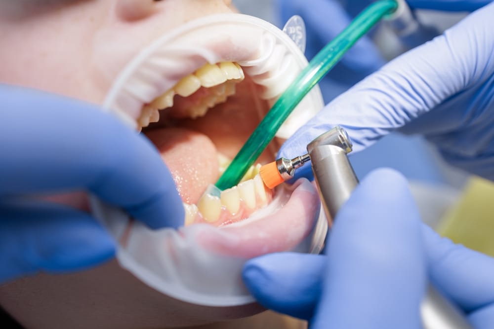 Is Dental Cleaning Painful? What Patients Should Know?