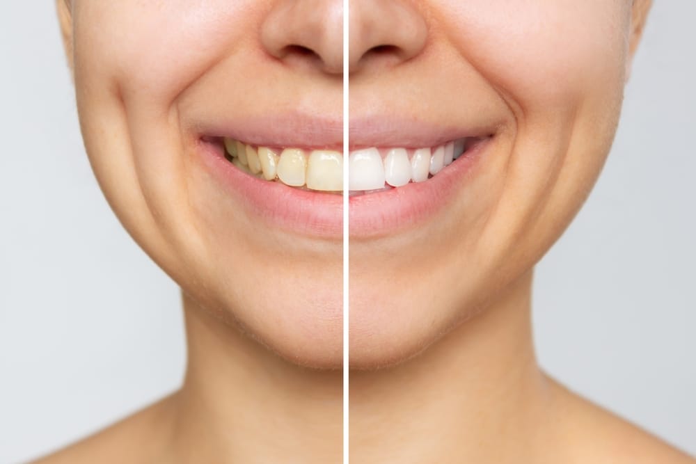 How To Prepare For Professional Teeth Whitening If You Have Sensitive Teeth?